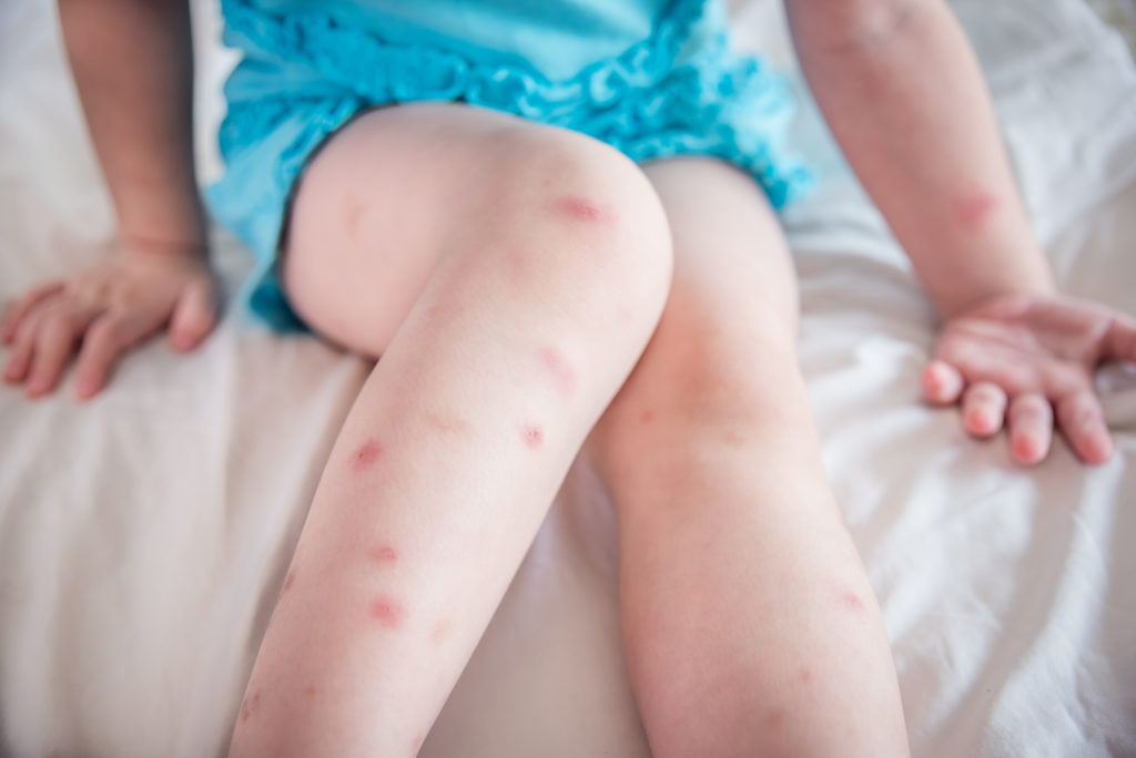 Red swollen Mosquito bites on a kid's legs and arms